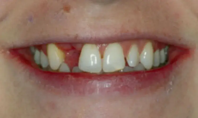Crooked front teeth and red gums are shown in a close-up of an open mouth.