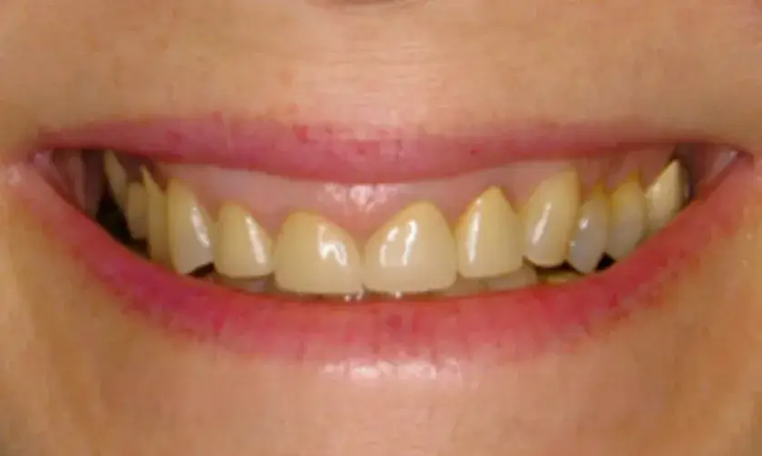A close-up of a smiling person's mouth showing teeth.