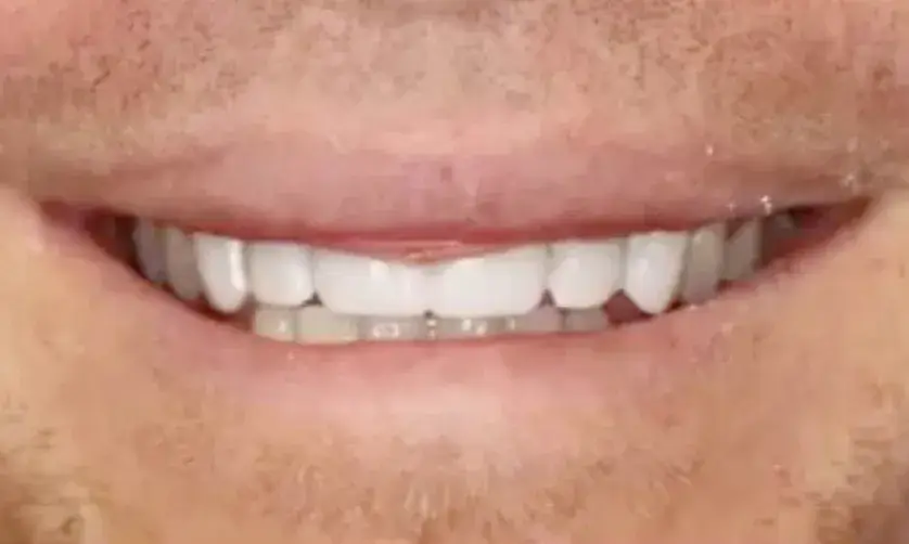 Close-up of a person smiling, showing clean, well-aligned teeth.