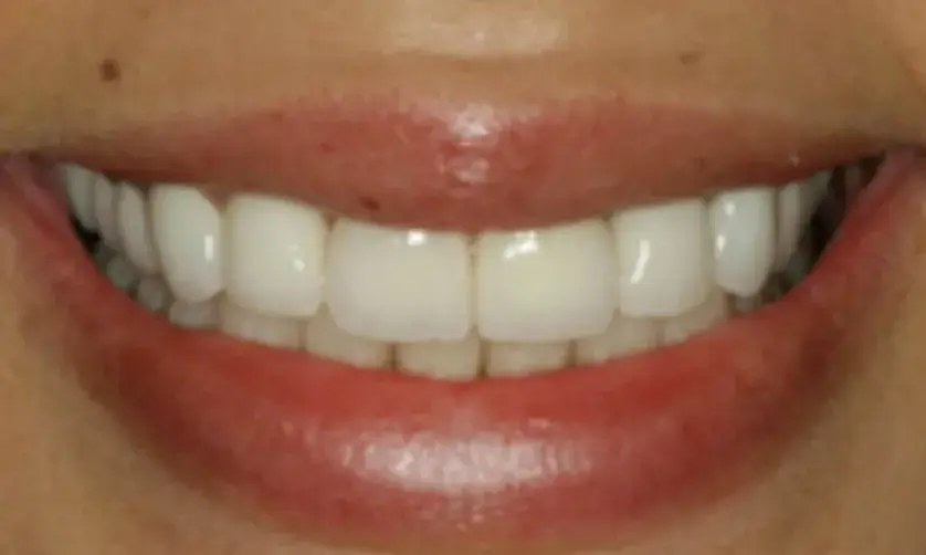 A person smiling, showing their white teeth.
