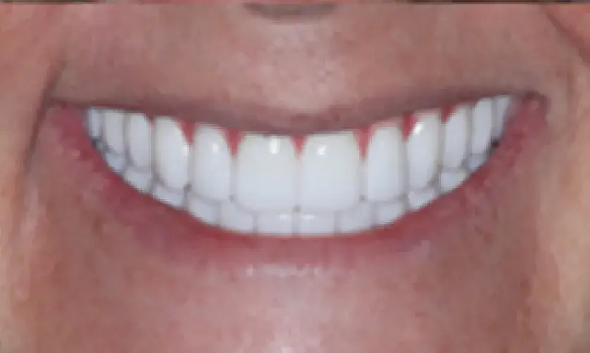Close-up of a wide smile showing bright white teeth.