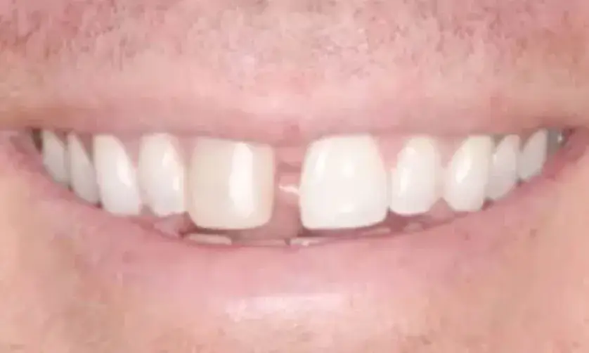 A close-up of a person smiling, showing a missing front tooth.