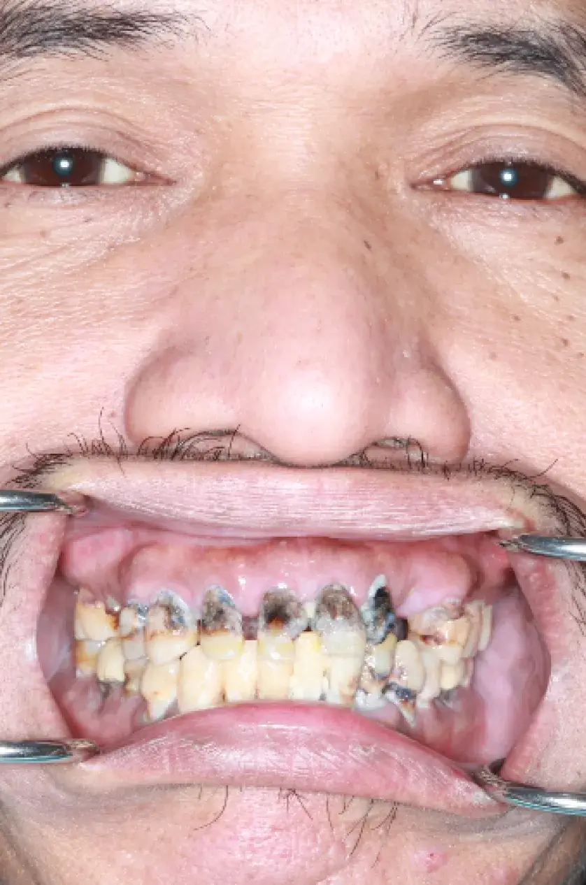 A close-up of a person's mouth showing severe tooth decay and dental issues.