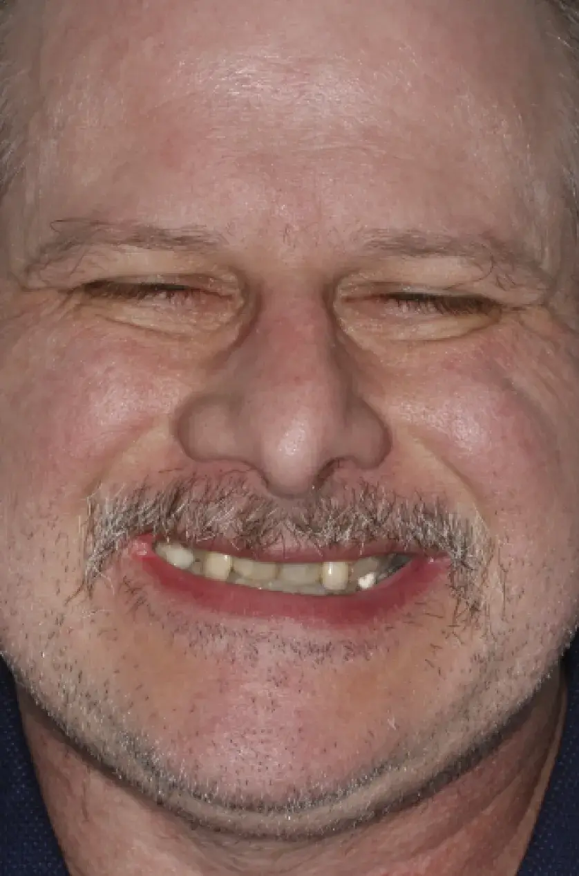 A man with a mustache smiles broadly, showing visible misalignment in his teeth.