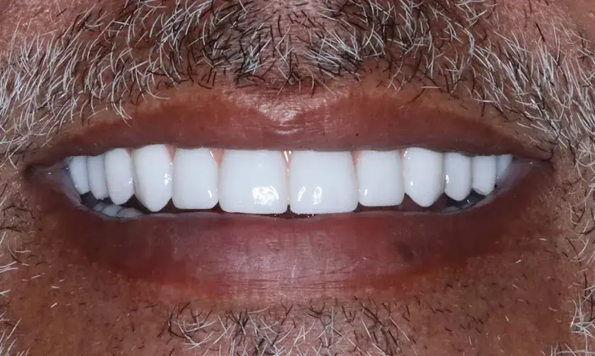 A person smiling with a full set of white, even teeth.