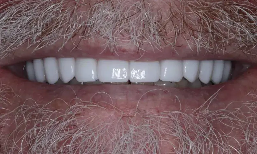 A close-up of a smiling mouth showing white, even teeth with facial hair visible.