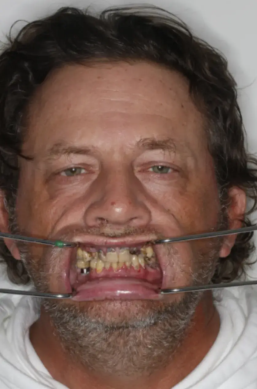 Person with dental retractor showing teeth for dental examination.