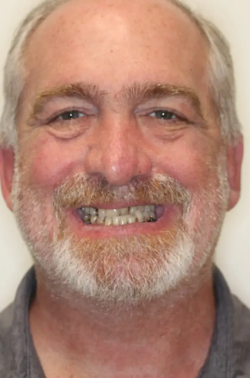 Smiling man with a gray beard showing yellow teeth against a plain background.