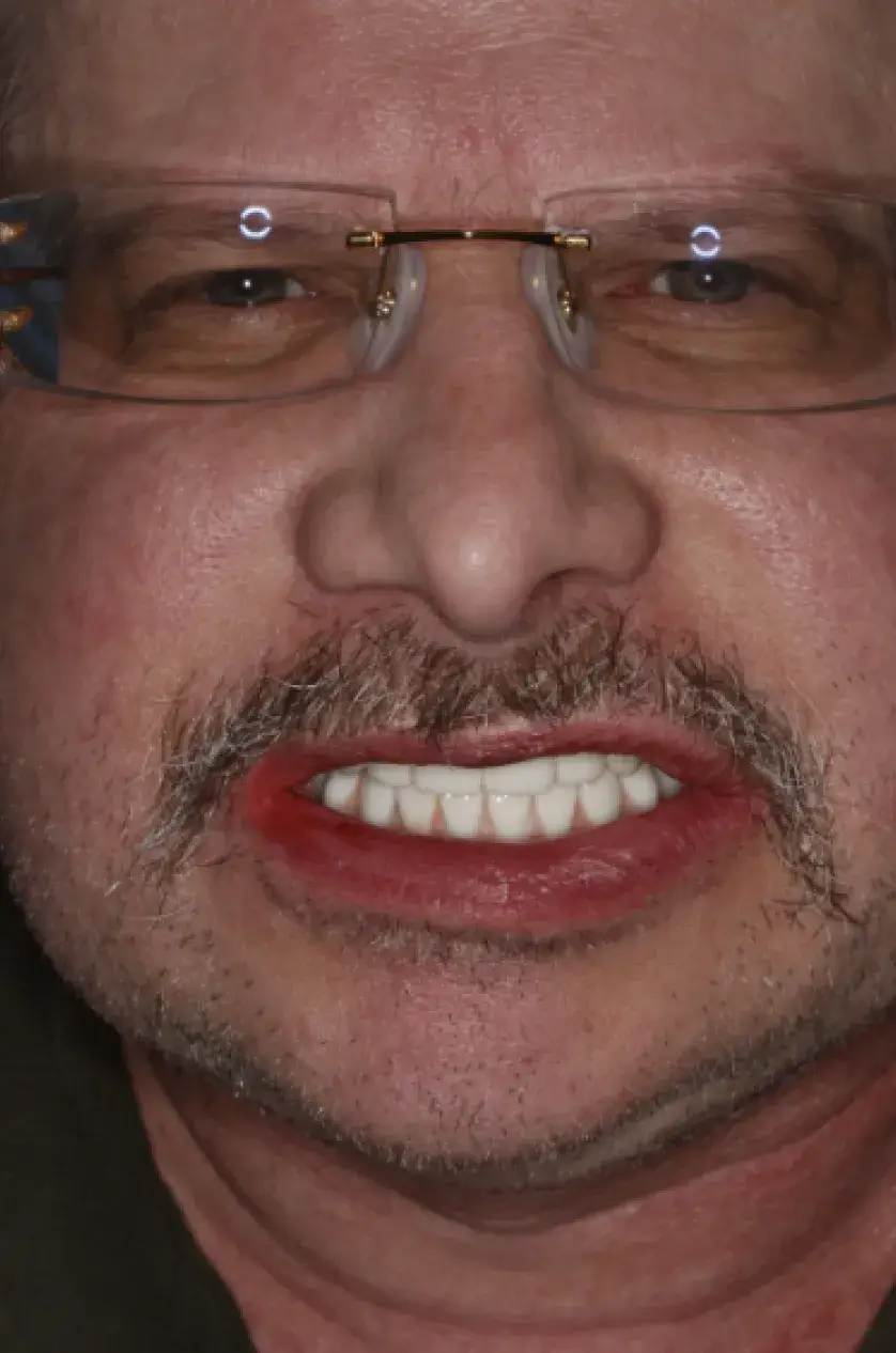 A man wearing glasses shows his teeth in an exaggerated smile.