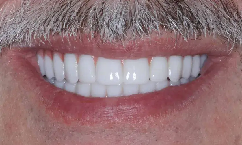 A close-up of a man's mouth showing a wide, bright smile with white teeth.