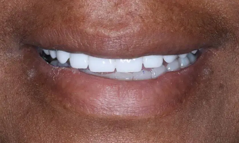A person is smiling, showing straight, white teeth.