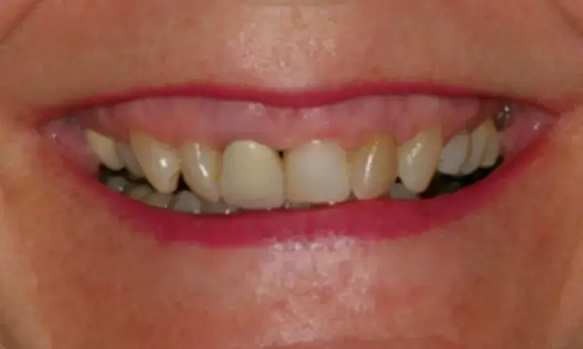 A close-up of a person's smile showing their teeth and gums.
