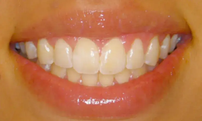 A person smiling, showing clean and well-aligned teeth.