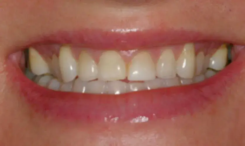 A close-up of a smiling person's mouth showing clean, well-aligned teeth.