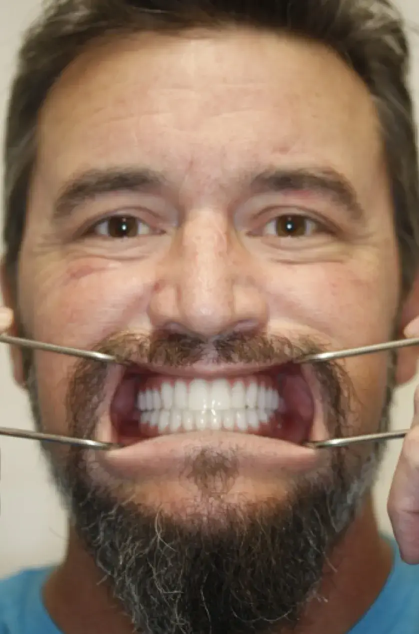 A man smiling widely, holding his mouth open with metal hooks.
