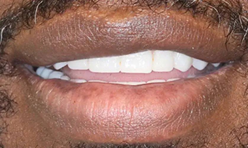 A close-up of a person smiling, showing white teeth and facial hair.