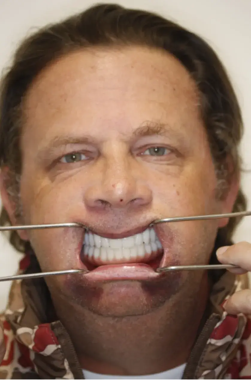 Man showing dental work with tools pulling back his lips, revealing white teeth.