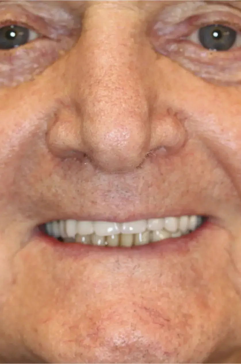 Close-up of an elderly person's face, showing a smile and visible teeth.
