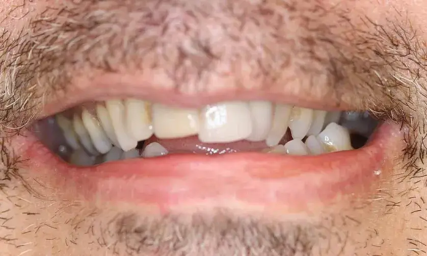 A close-up of a person's open mouth showing uneven and missing teeth.