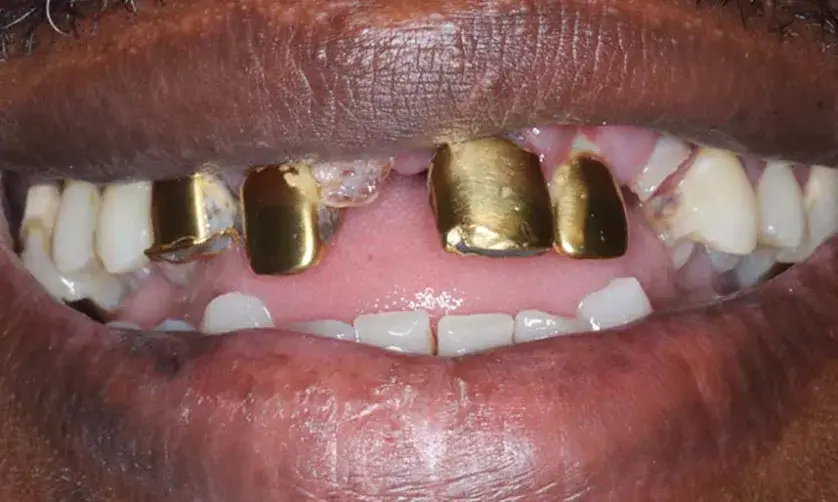 A mouth showing gold caps on multiple upper teeth.