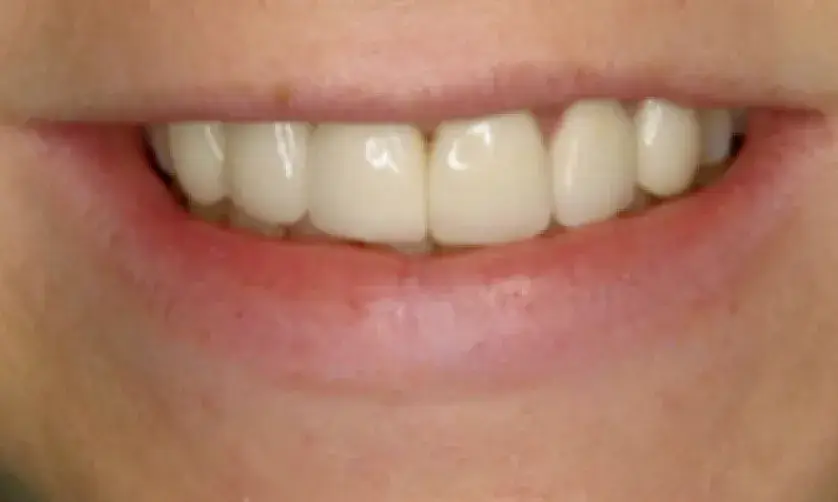 A close-up of a person's smiling mouth showing their teeth.