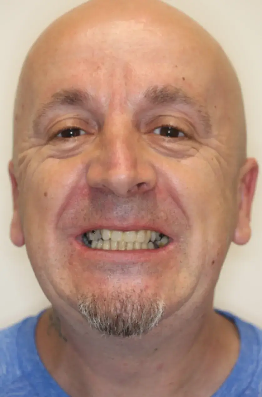 A bald man in a blue shirt shows his teeth while smiling.