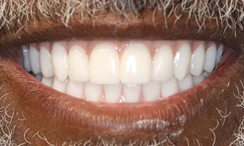 A person with a mustache is smiling, showing bright, even teeth.