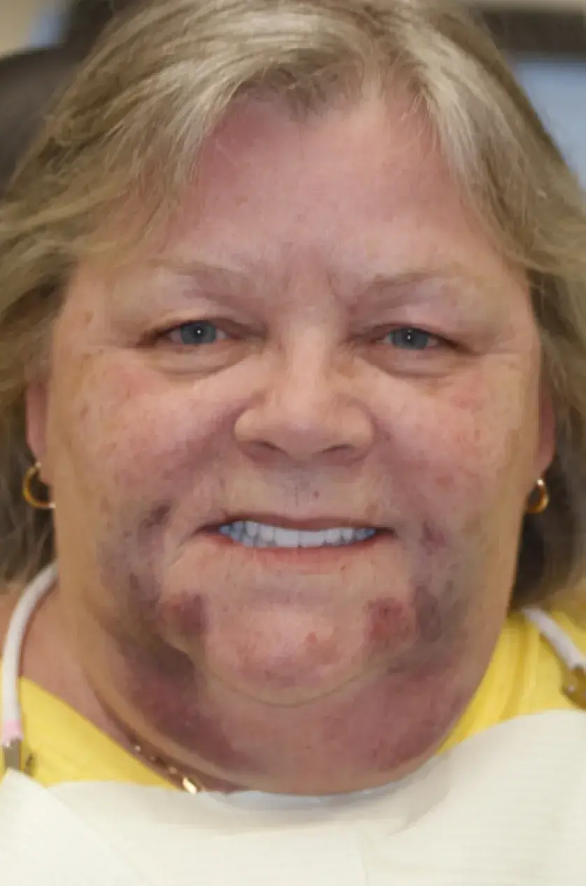 Smiling woman with light brown hair, wearing yellow, shows facial bruising.