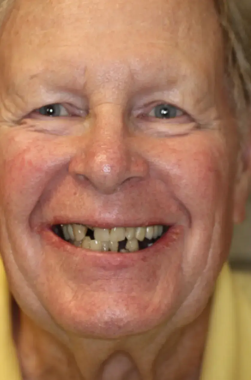 A person smiling widely, showing missing and uneven teeth.