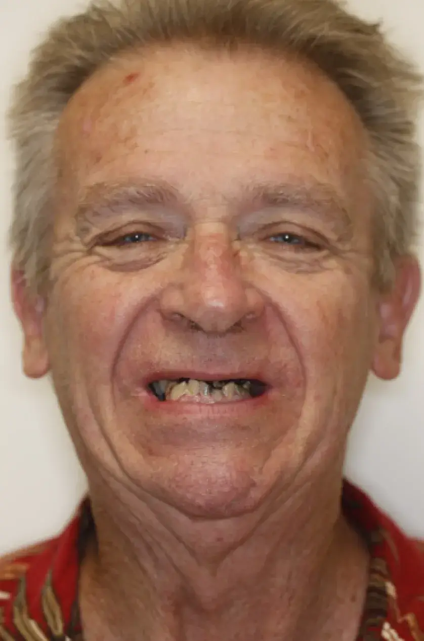 Smiling older man with missing and worn teeth, wearing a red shirt.