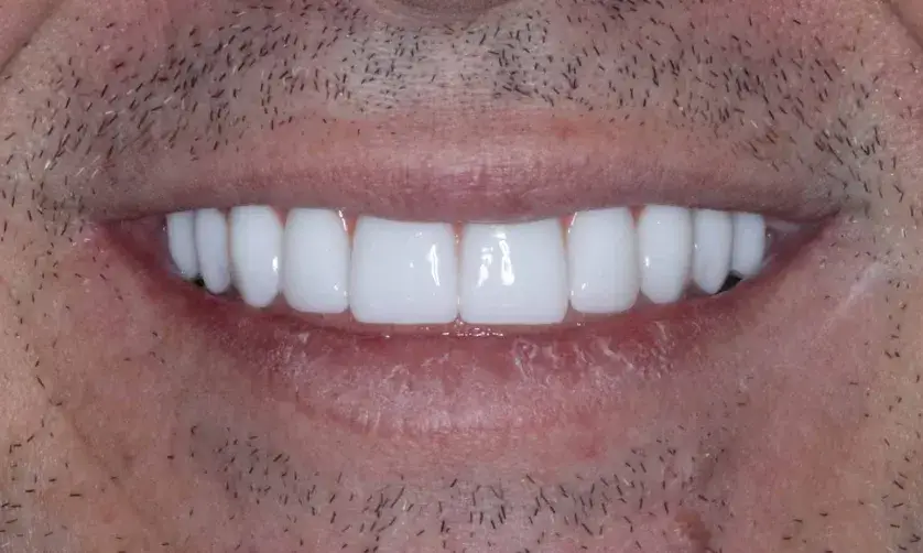 A person showing their teeth in a close-up photo, highlighting dental work.
