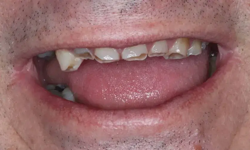 A person is showing their teeth, some of which are broken or chipped.