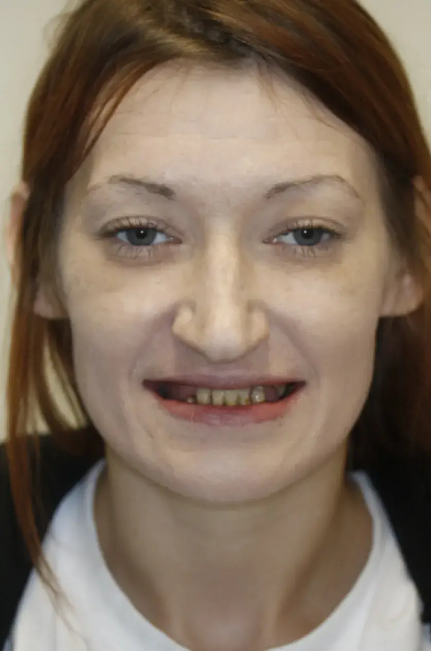 A person with brown hair and missing teeth is smiling at the camera.