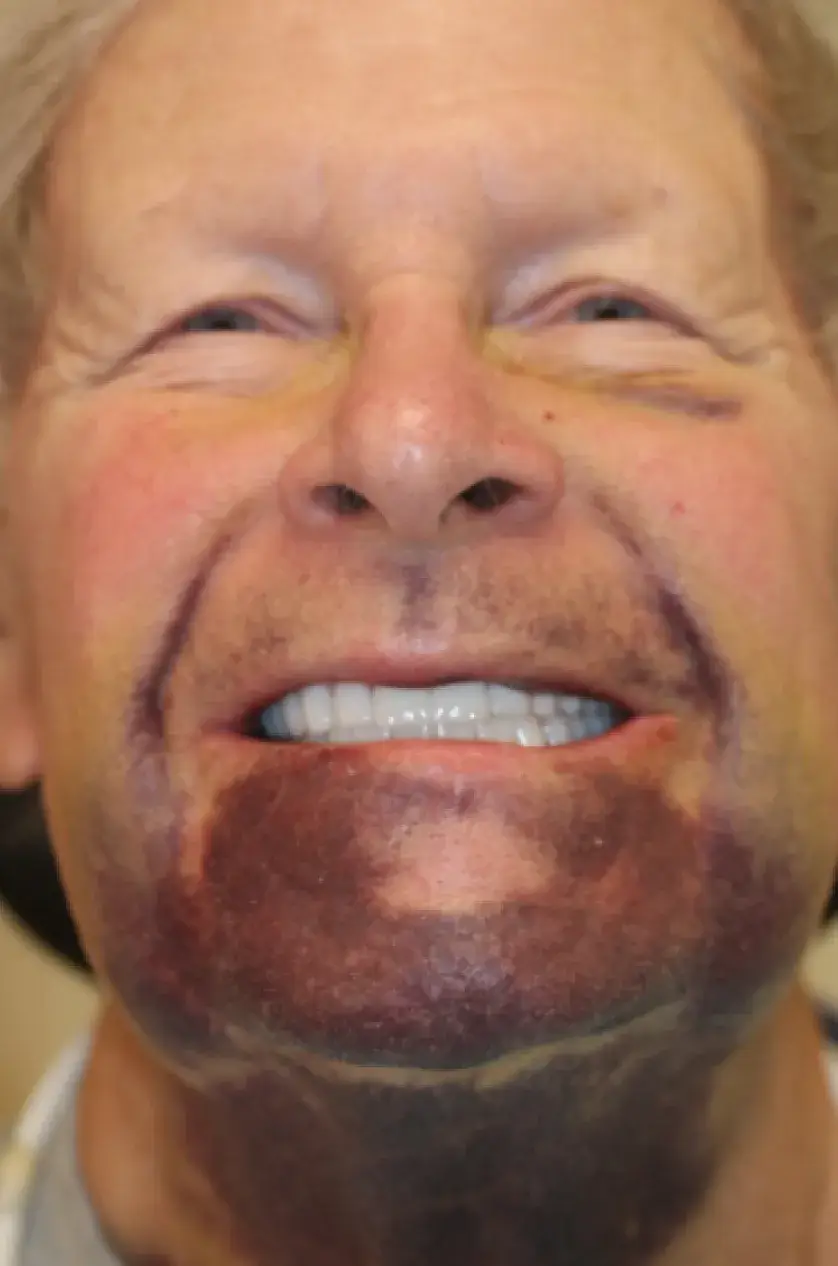 Person smiling with dark marks on their chin and cheeks.