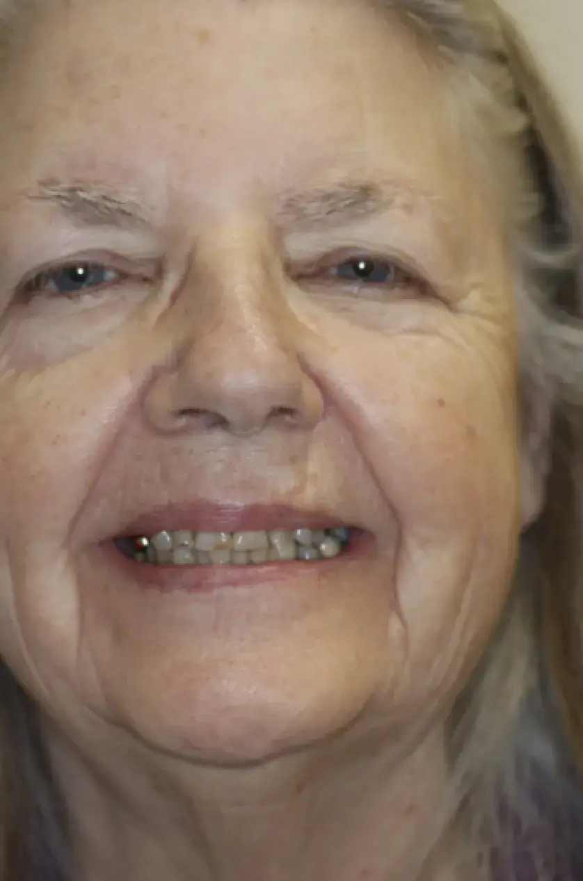 Elderly woman smiling directly at the camera, showing her teeth and wearing a neutral expression.