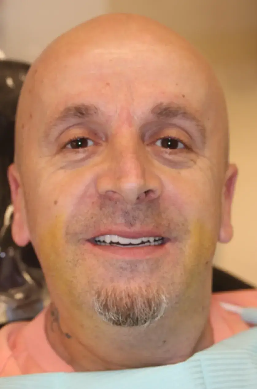 A person with a goatee smiling indoors, wearing a dental bib.