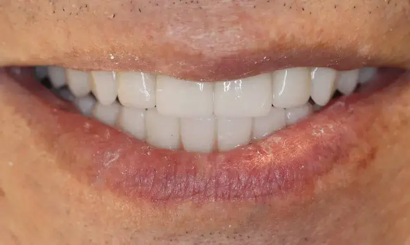 A close-up of a person's mouth showing a small smile with visible teeth.