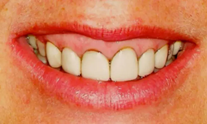 A close-up image of a person smiling, showing even, white teeth.