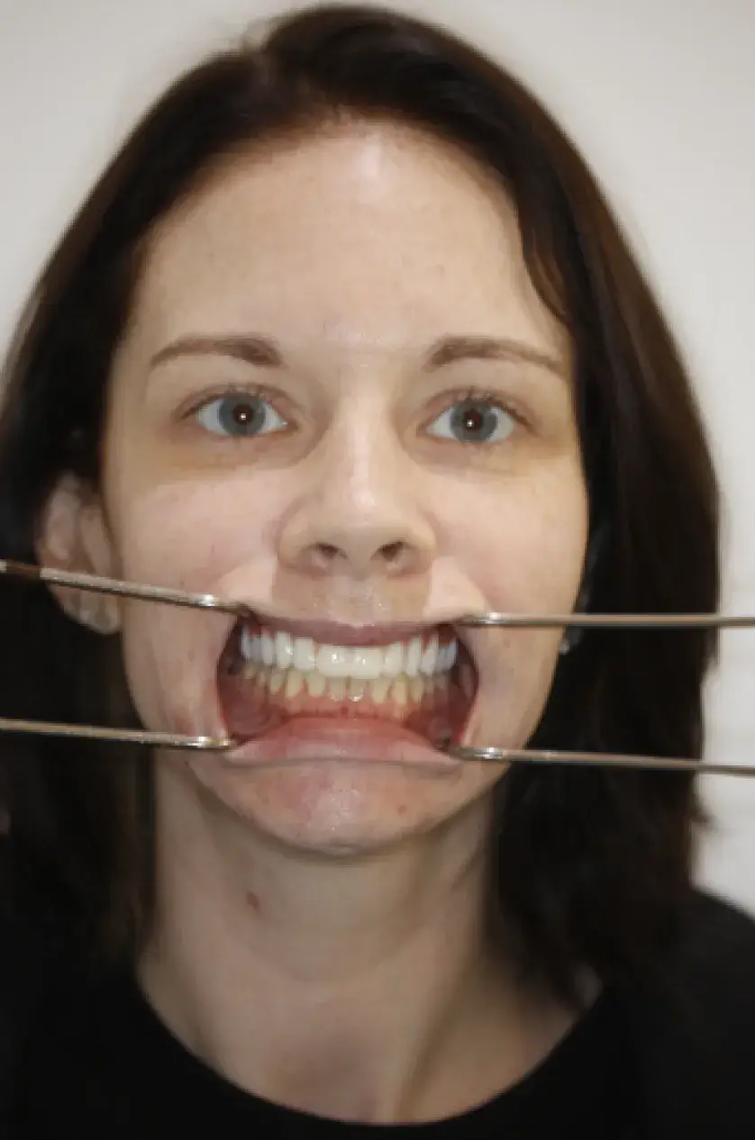 A woman with a dental cheek retractor in her mouth, showing her teeth.