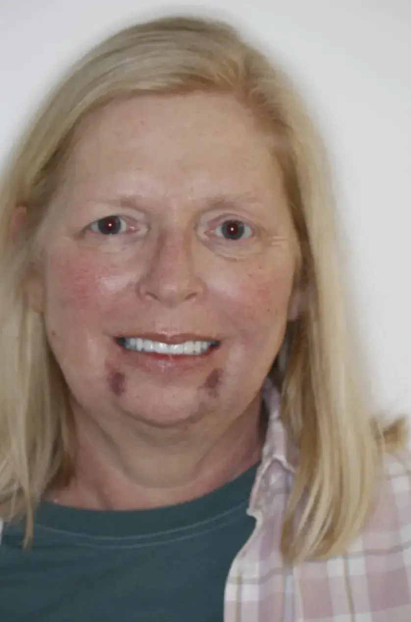 A woman with blonde hair is smiling, with visible marks on her chin and cheeks.