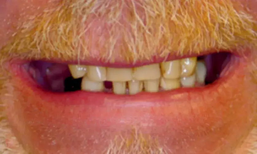 A close-up of a person’s mouth with missing and uneven teeth.