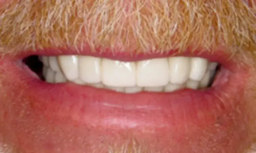 A close-up of a person's mouth showing slightly parted teeth and facial hair.