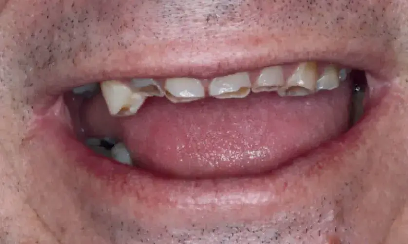 A person with a gap in their front teeth smiles, showing uneven and chipped teeth.