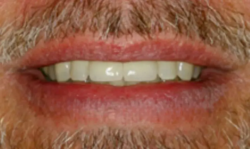 A close-up of a man's smiling mouth showing teeth and facial hair.