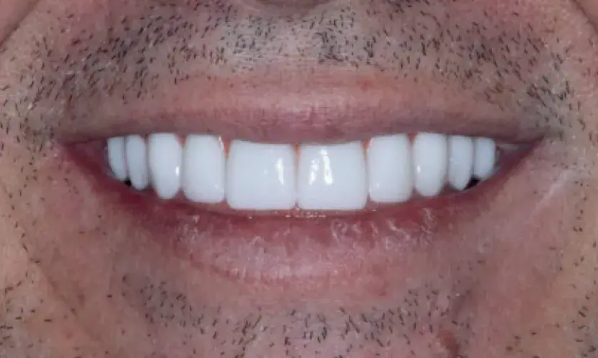A close-up of a person smiling, showing bright white teeth.