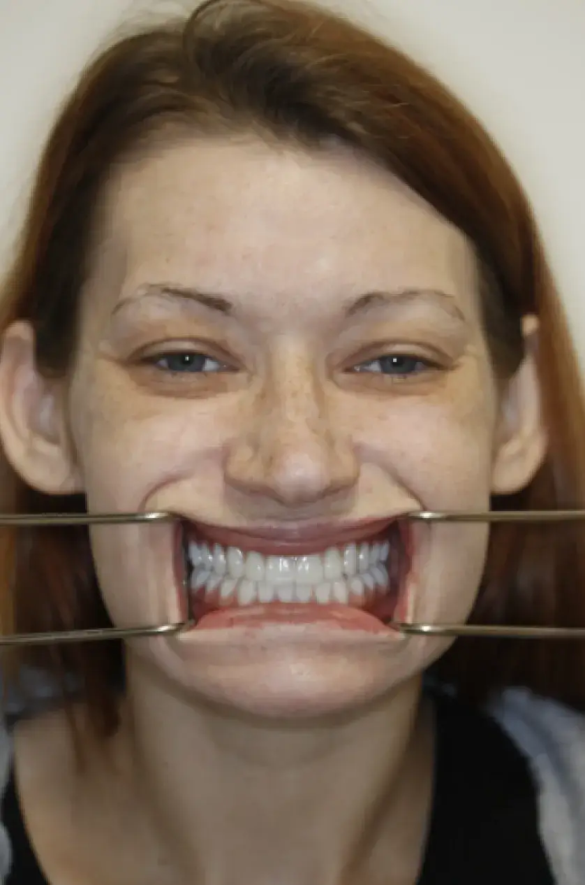 A person smiling widely with a dental retractor showing their teeth.