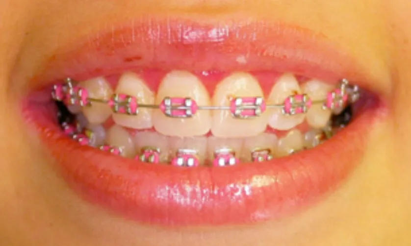 A close-up of a smiling mouth with pink braces on the teeth.