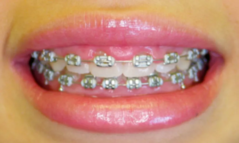 A close-up of a person's smile showing metal braces on their teeth.