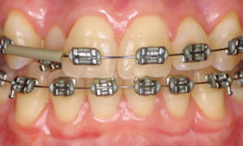 Close-up of teeth with metal braces and a rubber band connecting the top and bottom rows.