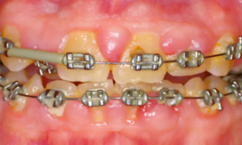 Close-up of teeth with braces, showing stained brackets and rubber bands connecting the upper and lower sets.